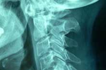 Salud: Patologas del hombro