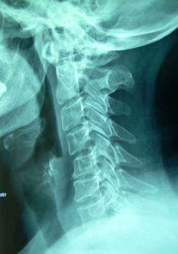 Una protusión cervical es una lesión que puede producirse por una sucesiva flexión y extensión brusca y excesiva del cuello.